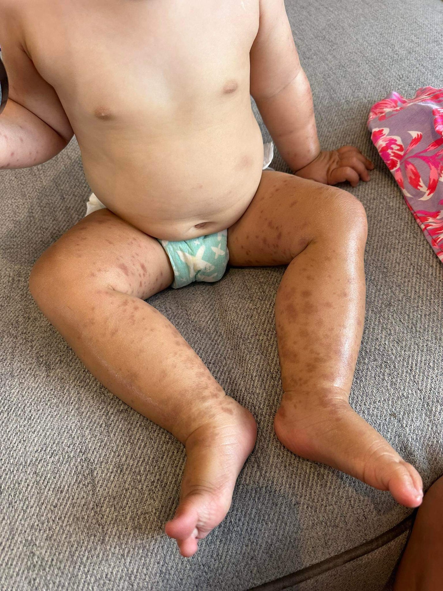 Kawakawa Hemp Balm NZ | Strong Eczema & Itchy Skin Relief